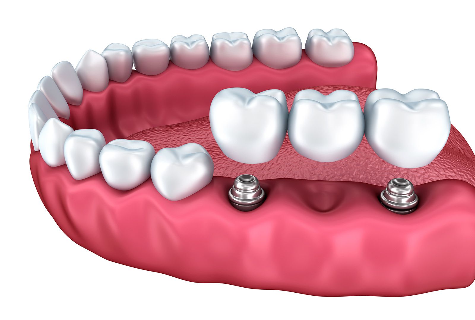 implant-supported bridge